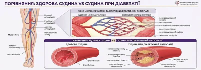 діабет та судини